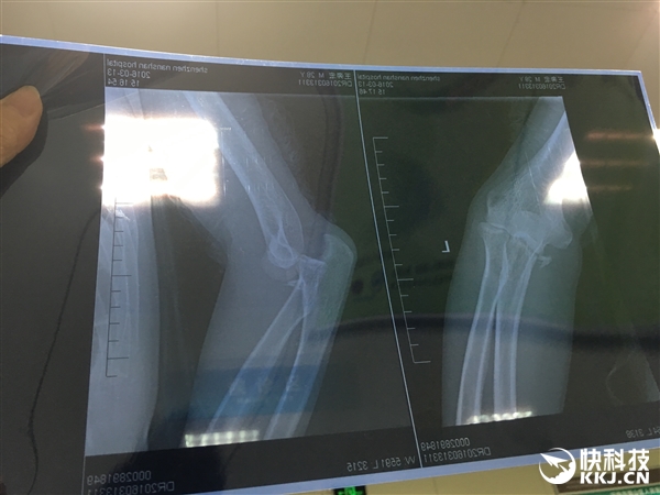 騎行小米九號平衡車摔骨折 官方回應：雨后路滑