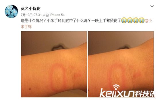 小米手環燙傷用戶？ 真假難辨誰之過
