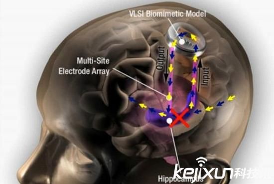記憶芯片植入大腦 或解決老年癡呆