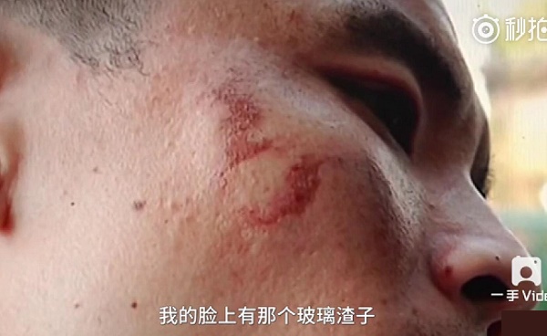 國行iPhone7中國首炸 果粉遭毀容